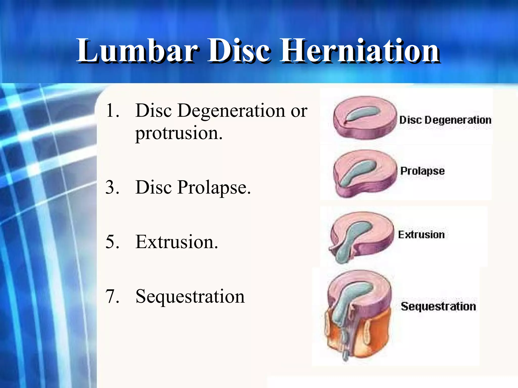 Lumbar Disc Herniation   Disc Degeneration or protrusion. Disc Prolapse. Extrusion. Sequestration 