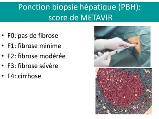 Ponction biopsie hépatique (PBH):
               score de METAVIR
•   F0: pas de fibrose
•   F1: fibrose minime
•   F2: fibrose modérée
•   F3: fibrose sévère
•   F4: cirrhose




                                           17
 