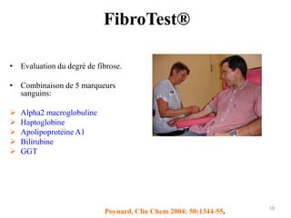 FibroTest®

• Evaluation du degré de fibrose.

• Combinaison de 5 marqueurs
  sanguins:

   Alpha2 macroglobuline
   Haptoglobine
   Apolipoprotéine A1
   Bilirubine
   GGT




                                                                   18
                            Poynard, Clin Chem 2004; 50:1344-55.
 