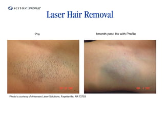 Laser Hair Removal
                      Pre                                              1month post 1tx with Profile




Photo’s courtesy of Arkansas Laser Solutions, Fayetteville, AR 72703
 
