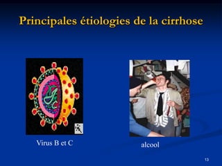 Principales étiologies de la cirrhose




   Virus B et C         alcool
                                        13
 