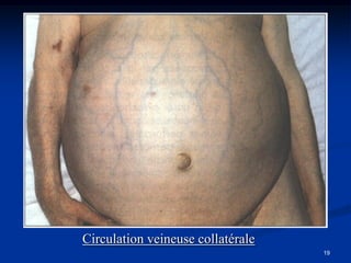 Circulation veineuse collatérale
                                   19
 