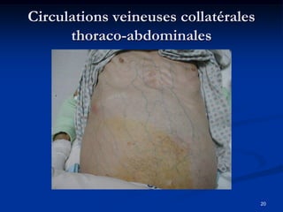 Circulations veineuses collatérales
      thoraco-abdominales




                                      20
 