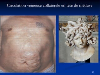 Circulation veineuse collatérale en tête de méduse




                                                 21
 