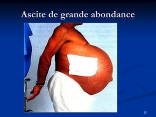Ascite de grande abondance




                             22
 