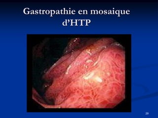 Gastropathie en mosaique
         d’HTP




                           29
 