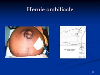 Hernie ombilicale




                    36
 