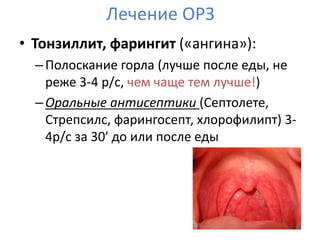 Лечение ОРЗ
• Тонзиллит, фарингит («ангина»):
  – Полоскание горла (лучше после еды, не
    реже 3-4 р/с, чем чаще тем лучше!)
  – Оральные антисептики (Септолете,
    Стрепсилс, фарингосепт, хлорофилипт) 3-
    4р/с за 30′ до или после еды
 