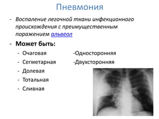 Пневмония
- Воспаление легочной ткани инфекционного
  происхождения с преимущественным
  поражением альвеол
- Может быть:
  -   Очаговая      -Односторонняя
  -   Сегметарная   -Двухсторонняя
  -   Долевая
  -   Тотальная
  -   Сливная
 