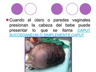 Cuando el útero o paredes vaginales
presionan la cabeza del bebe puede
presentar lo que se llama CAPUT
SUCCEDANEUM O SIMPLEMENTE CAPUT