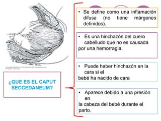 ¿QUE ES EL CAPUT
SECCEDANEUM?
• Se define como una inflamación
difusa (no tiene márgenes
definidos).
• Es una hinchazón del cuero
cabelludo que no es causada
por una hemorragia.
• Aparece debido a una presión
en
la cabeza del bebé durante el
parto.
• Puede haber hinchazón en la
cara si el
bebé ha nacido de cara