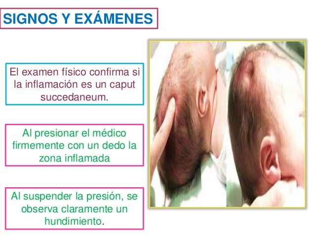 caput succedaneum