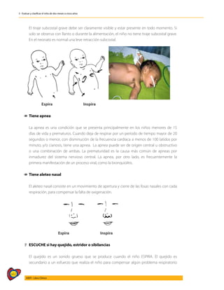 442
AIEPI - Libro Clínico
3 - Evaluar y clasificar el niño de dos meses a cinco años
	 El tiraje subcostal grave debe ser claramente visible y estar presente en todo momento. Si
solo se observa con llanto o durante la alimentación, el niño no tiene tiraje subcostal grave.
En el neonato es normal una leve retracción subcostal.
Espira 	 Inspira
1
1 Tiene apnea
	
	 La apnea es una condición que se presenta principalmente en los niños menores de 15
días de vida y prematuros. Cuando deja de respirar por un período de tiempo mayor de 20
segundos o menor, con disminución de la frecuencia cardíaca a menos de 100 latidos por
minuto, y/o cianosis, tiene una apnea. La apnea puede ser de origen central u obstructivo
o una combinación de ambas. La prematuridad es la causa más común de apneas por
inmadurez del sistema nervioso central. La apnea, por otro lado, es frecuentemente la
primera manifestación de un proceso viral, como la bronquiolitis.
1
1 Tiene aleteo nasal
	
	 El aleteo nasal consiste en un movimiento de apertura y cierre de las fosas nasales con cada
respiración, para compensar la falta de oxigenación.
	 Espira			 Inspira
2
2 ESCUCHE si hay quejido, estridor o sibilancias
	 El quejido es un sonido grueso que se produce cuando el niño ESPIRA. El quejido es
secundario a un esfuerzo que realiza el niño para compensar algún problema respiratorio
 