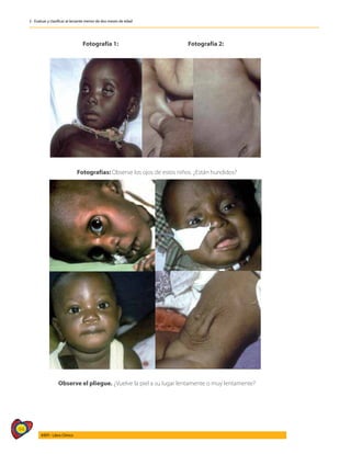 94
AIEPI - Libro Clínico
2 - Evaluar y clasificar al lactante menor de dos meses de edad
Fotografías: Observe los ojos de estos niños. ¿Están hundidos?
Fotografía 1: Fotografía 2:
Observe el pliegue. ¿Vuelve la piel a su lugar lentamente o muy lentamente?
 