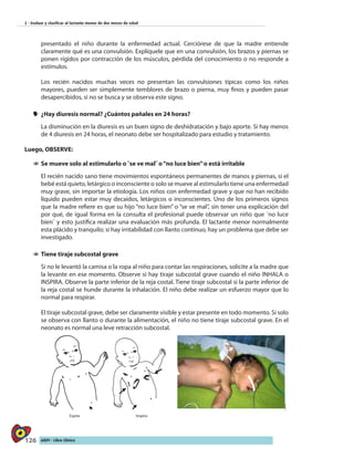 126 AIEPI - Libro Clínico
2 - Evaluar y clasificar al lactante menor de dos meses de edad
presentado el niño durante la enfermedad actual. Cerciórese de que la madre entiende
claramente qué es una convulsión. Explíquele que en una convulsión, los brazos y piernas se
ponen rígidos por contracción de los músculos, pérdida del conocimiento o no responde a
estímulos.
Los recién nacidos muchas veces no presentan las convulsiones típicas como los niños
mayores, pueden ser simplemente temblores de brazo o pierna, muy finos y pueden pasar
desapercibidos, si no se busca y se observa este signo.
yy ¿Hay diuresis normal? ¿Cuántos pañales en 24 horas?
La disminución en la diuresis es un buen signo de deshidratación y bajo aporte. Si hay menos
de 4 diuresis en 24 horas, el neonato debe ser hospitalizado para estudio y tratamiento.
Luego, OBSERVE:
11 	Se mueve solo al estimularlo o ¨se ve mal¨ o“no luce bien”o está irritable
El recién nacido sano tiene movimientos espontáneos permanentes de manos y piernas, si el
bebé está quieto, letárgico o inconsciente o solo se mueve al estimularlo tiene una enfermedad
muy grave, sin importar la etiología. Los niños con enfermedad grave y que no han recibido
líquido pueden estar muy decaídos, letárgicos o inconscientes. Uno de los primeros signos
que la madre refiere es que su hijo “no luce bien” o “se ve mal”, sin tener una explicación del
por qué, de igual forma en la consulta el profesional puede observar un niño que ¨no luce
bien¨ y esto justifica realizar una evaluación más profunda. El lactante menor normalmente
esta plácido y tranquilo; si hay irritabilidad con llanto continuo, hay un problema que debe ser
investigado.
11 	Tiene tiraje subcostal grave
Si no le levantó la camisa o la ropa al niño para contar las respiraciones, solicite a la madre que
la levante en ese momento. Observe si hay tiraje subcostal grave cuando el niño INHALA o
INSPIRA. Observe la parte inferior de la reja costal. Tiene tiraje subcostal si la parte inferior de
la reja costal se hunde durante la inhalación. El niño debe realizar un esfuerzo mayor que lo
normal para respirar.
El tiraje subcostal grave, debe ser claramente visible y estar presente en todo momento. Si solo
se observa con llanto o durante la alimentación, el niño no tiene tiraje subcostal grave. En el
neonato es normal una leve retracción subcostal.
|
Espira Inspira
 