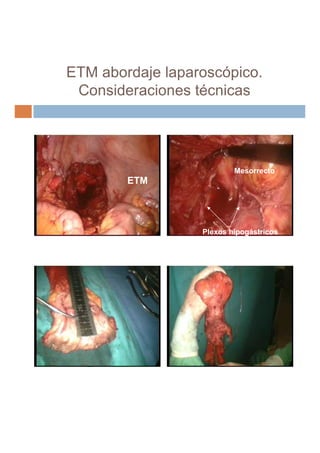 ETM abordaje laparoscópico.
 Consideraciones técnicas




                          Mesorrecto
        ETM




           ...
