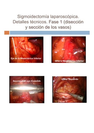 Sigmoidectomía laparoscópica.
 Detalles técnicos. Fase 1 (disección
       y sección de los vasos)




Eje de la Mesentéri...