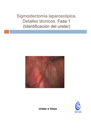 Sigmoidectomía laparoscópica.
   Detalles técnicos. Fase 1
   (Identificación del ureter)




           Ureter e iliaca