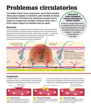 Problemas circulatorios
Los tejidos tienen vasos sanguíneos, cuyas finas paredes
dejan pasar oxígeno y nutrientes, pero también se dañan
con facilidad. El sistema de reparación permite que la
sangre se coagule para arreglar cualquier daño, pero a
veces algún coágulo no deseado crea un tapón.
Moretones
A veces un golpe en alguna parte del cuerpo provoca la rotura de pequeños
vasos sanguíneos y la sangre inunda los tejidos vecinos. Hay personas más
propensas a tener moretones que otras, sobre todo los ancianos, y suele estar
relacionado con trastornos de la coagulación o deficiencia de nutrientes
como las vitaminas K (necesaria para crear factores de
coagulación) o C (necesaria para crear el colágeno).
Este capilar roto
pierde sangre
¿POR QUÉ SE
SUFRE TROMBOSIS
VENOSA PROFUNDA EN
VUELOS LARGOS?
A veces la sangre fluye lenta y
se coagula por error en un vaso
sano, especialmente si se está
sentado durante horas. Este
coágulo, o trombosis,
puede taponar
una vena.
Pelo
La sangre se acumula de
manera visible en la capa
superior de la piel
Coagulación
Cualquier daño en un vaso sanguíneo debe sellarse
rápidamente para no perder sangre. Una secuencia
compleja de reacciones provoca que las proteínas
inactivas disueltas en la sangre se activen y taponen el
daño. El vaso sanguíneo se constriñe para frenar el flujo
sanguíneo y reducir la pérdida de sangre de la circulación.
Pared del vaso
sanguíneo rota Acumulación de plaquetas
Las fibras de proteína
fibrina unen las plaquetas
Abertura inicial
La exposición de proteínas como el
colágeno de una pared de vaso sanguíneo
rota atrae inmediatamente las plaquetas.
Formación del coágulo
Las plaquetas se unen y liberan agentes
químicos para que la fibrina (una proteína de
la sangre) forme fibras.
Fijación del coágulo
Una red pegajosa de fibras de fibrina
une las plaquetas y captura glóbulos rojos
para que formen un coágulo.
1 2 3
Pérdida de sangre
La sangre circula a presión y se escapa
rápidamente a los tejidos vecinos si se
rompe un vaso. Los agentes químicos
liberados activan la coagulación y
atraen a los fagocitos (macrófagos).
MORETÓN
Plaqueta
 
