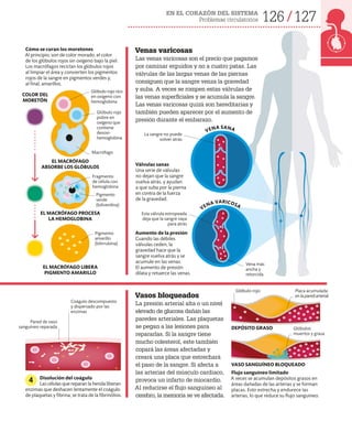 126 127
EN EL CORAZÓN DEL SISTEMA
Problemas circulatorios
Venas varicosas
Las venas varicosas son el precio que pagamos
por caminar erguidos y no a cuatro patas. Las
válvulas de las largas venas de las piernas
consiguen que la sangre venza la gravedad
y suba. A veces se rompen estas válvulas de
las venas superficiales y se acumula la sangre.
Las venas varicosas quizá son hereditarias y
también pueden aparecer por el aumento de
presión durante el embarazo.
Aumento de la presión
Cuando las débiles
válvulas ceden, la
gravedad hace que la
sangre vuelva atrás y se
acumule en las venas.
El aumento de presión
dilata y retuerce las venas.
Esta válvula estropeada
deja que la sangre vaya
para atrás
Válvulas sanas
Una serie de válvulas
no dejan que la sangre
vuelva atrás, y ayudan
a que suba por la pierna
en contra de la fuerza
de la gravedad.
Vena más
ancha y
retorcida
La sangre no puede
volver atrás
Cómo se curan los moretones
Al principio, son de color morado, el color
de los glóbulos rojos sin oxígeno bajo la piel.
Los macrófagos reciclan los glóbulos rojos
al limpiar el área y convierten los pigmentos
rojos de la sangre en pigmentos verdes y,
al final, amarillos.
Glóbulo rojo rico
en oxígeno con
hemoglobina
Glóbulo rojo
pobre en
oxígeno que
contiene
desoxi-
hemoglobina
Pigmento
verde
(biliverdina)
Pigmento
amarillo
(bilirrubina)
COLOR DEL
MORETÓN
EL MACRÓFAGO
ABSORBE LOS GLÓBULOS
Vasos bloqueados
La presión arterial alta o un nivel
elevado de glucosa dañan las
paredes arteriales. Las plaquetas
se pegan a las lesiones para
repararlas. Si la sangre tiene
mucho colesterol, este también
copará las áreas afectadas y
creará una placa que estrechará
el paso de la sangre. Si afecta a
las arterias del músculo cardiaco,
provoca un infarto de miocardio.
Al reducirse el flujo sanguíneo al
cerebro, la memoria se ve afectada.
Flujo sanguíneo limitado
A veces se acumulan depósitos grasos en
áreas dañadas de las arterias y se forman
placas. Esto estrecha y endurece las
arterias, lo que reduce su flujo sanguíneo.
Placa acumulada
enlaparedarterial
Glóbulo rojo
Glóbulos
muertos y grasa
Pared de vaso
sanguíneo reparada
Disolución del coágulo
Las células que reparan la herida liberan
enzimas que deshacen lentamente el coágulo
de plaquetas y fibrina; se trata de la fibrinólisis.
4
DEPÓSITO GRASO
VASO SANGUÍNEO BLOQUEADO
VENA SANA
VENA VARICOSA
Coágulo descompuesto
y dispersado por las
enzimas
Macrófago
EL MACRÓFAGO PROCESA
LA HEMOGLOBINA
EL MACRÓFAGO LIBERA
PIGMENTO AMARILLO
Fragmento
de célula con
hemoglobina
 