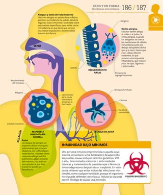SANO Y EN FORMA
Problemas inmunitarios 186 187
Alergias y estilo de vida moderno
Hay más alergias en países desarrollados;
además, su incidencia ha subido desde la
Segunda Guerra Mundial. Se debate sobre
sus motivos específicos, pero existe cierta
coincidencia en que tiene que ver con
una menor exposición a los microbios
durante la infancia.
Asma
Un ataque de asma es un
espasmo de los bronquios
pulmonares que provoca
sibilancia, tos y dificultades
respiratorias. Aparece como
respuesta alérgica de los
pulmones a algún irritante
del entorno. Hay indicios
que apuntan a que este
trastorno puede ser
hereditario.
Rinitis alérgica
Muchos tienen alergia
al polen o al polvo, la
rinitis alérgica. Cuando
los alérgenos se unen a
las membranas de células
inmunitarias justo por
debajo del epitelio de los
ojos y la nariz, hacen que
estas células liberen
histamina, lo que
provoca una respuesta
inflamatoria, que incluye
picor de ojos, lágrimas
y estornudos.
SENO
Una persona inmunocomprometida es aquella cuyo
sistema inmunitario se ha debilitado o desaparecido;
las posibles causas incluyen defectos genéticos, VIH
o sida, determinados cánceres o enfermedades
crónicas, y tratamientos de quimioterapia o fármacos
inmunodepresores después de un trasplante. En estos
casos se tienen que evitar incluso las infecciones más
simples, como cualquier resfriado, porque el organismo
no se puede defender con eficacia. Incluso las vacunas
corren el riesgo de causar una infección.
INMUNIDAD BAJO MÍNIMOS
RESPUESTA
INMUNITARIA
NORMAL
RECUBRIMIENTO
NASAL
P
U
L
M
Ó
N
ATAQUE DE ASMA
PELIGRO BIOLÓGICO
Alérgeno
Epitelio
Las citocinas
de la célula
inmunitaria
propician la
hinchazón
Alérgeno
El mastocito
segrega histaminas
Moco
Célula inmunitaria
Vía aérea
constreñida
Citocina
Bronquio hinchado
Recubrimiento
del bronquio
 
