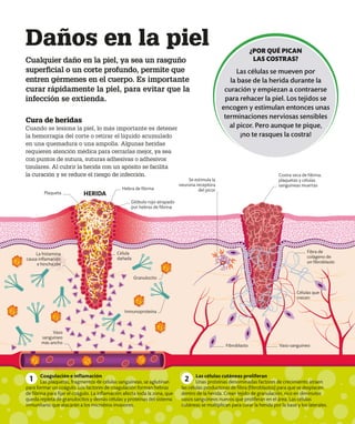 Vaso sanguíneo
Fibroblasto
Fibra de
colágeno de
un fibroblasto
Vaso
sanguíneo
más ancho
Daños en la piel
Cualquier daño en la piel, ya sea un rasguño
superficial o un corte profundo, permite que
entren gérmenes en el cuerpo. Es importante
curar rápidamente la piel, para evitar que la
infección se extienda.
Cura de heridas
Cuando se lesiona la piel, lo más importante es detener
la hemorragia del corte o retirar el líquido acumulado
en una quemadura o una ampolla. Algunas heridas
requieren atención médica para cerrarlas mejor, ya sea
con puntos de sutura, suturas adhesivas o adhesivos
tisulares. Al cubrir la herida con un apósito se facilita
la curación y se reduce el riesgo de infección.
Inmunoproteína
¿POR QUÉ PICAN
LAS COSTRAS?
Las células se mueven por
la base de la herida durante la
curación y empiezan a contraerse
para rehacer la piel. Los tejidos se
encogen y estimulan entonces unas
terminaciones nerviosas sensibles
al picor. Pero aunque te pique,
¡no te rasques la costra!
Coagulación e inflamación
Las plaquetas, fragmentos de células sanguíneas, se aglutinan
para formar un coágulo. Los factores de coagulación forman hebras
de fibrina para fijar el coágulo. La inflamación afecta toda la zona, que
queda repleta de granulocitos y demás células y proteínas del sistema
inmunitario que atacarán a los microbios invasores.
1 Las células cutáneas proliferan
Unas proteínas denominadas factores de crecimiento atraen
las células productoras de fibra (fibroblastos) para que se desplacen
dentro de la herida. Crean tejido de granulación, rico en diminutos
vasos sanguíneos nuevos que proliferan en el área. Las células
cutáneas se multiplican para curar la herida por la base y los laterales.
2
Se estimula la
neurona receptora
del picor
Costra seca de fibrina,
plaquetas y células
sanguíneas muertas
Glóbulo rojo atrapado
por hebras de fibrina
Hebra de fibrina
Plaqueta HERIDA
Granulocito
Célula
dañada
La histamina
causa inflamación
e hinchazón
Células que
crecen
 
