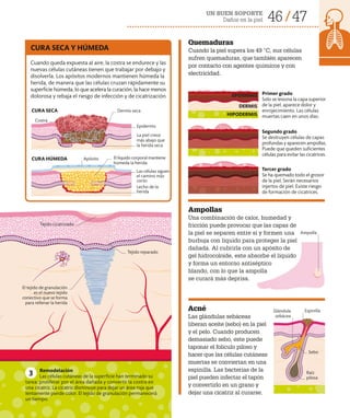 46 47
UN BUEN SOPORTE
Daños en la piel
Acné
Las glándulas sebáceas
liberan aceite (sebo) en la piel
y el pelo. Cuando producen
demasiado sebo, este puede
taponar el folículo piloso y
hacer que las células cutáneas
muertas se conviertan en una
espinilla. Las bacterias de la
piel pueden infectar el tapón
y convertirlo en un grano y
dejar una cicatriz al curarse.
Primer grado
Solo se lesiona la capa superior
de la piel, aparece dolor y
enrojecimiento. Las células
muertas caen en unos días.
Tercer grado
Se ha quemado todo el grosor
de la piel. Serán necesarios
injertos de piel. Existe riesgo
de formación de cicatrices.
Segundo grado
Se destruyen células de capas
profundas y aparecen ampollas.
Puede que queden suficientes
células para evitar las cicatrices.
Quemaduras
Cuando la piel supera los 49 °C, sus células
sufren quemaduras, que también aparecen
por contacto con agentes químicos y con
electricidad.
Ampollas
Una combinación de calor, humedad y
fricción puede provocar que las capas de
la piel se separen entre sí y formen una
burbuja con líquido para proteger la piel
dañada. Al cubrirla con un apósito de
gel hidrocoloide, este absorbe el líquido
y forma un entorno antiséptico
blando, con lo que la ampolla
se curará más deprisa.
Apósito El líquido corporal mantiene
húmeda la herida
Dermis seca
Costra
Tejido reparado
Tejido cicatrizado
Epidermis
La piel crece
más abajo que
la herida seca
Lecho de la
herida
Las células siguen
el camino más
corto
Espinilla
Cuando queda expuesta al aire, la costra se endurece y las
nuevas células cutáneas tienen que trabajar por debajo y
disolverla. Los apósitos modernos mantienen húmeda la
herida, de manera que las células cruzan rápidamente su
superficie húmeda, lo que acelera la curación, la hace menos
dolorosa y rebaja el riesgo de infección y de cicatrización.
CURA SECA Y HÚMEDA
Remodelación
Las células cutáneas de la superficie han terminado su
tarea: proliferar por el área dañada y convertir la costra en
una cicatriz. La cicatriz disminuye para dejar un área roja que
lentamente pierde color. El tejido de granulación permanecerá
un tiempo.
3
CURA HÚMEDA
CURA SECA
Raíz
pilosa
Sebo
Glándula
sebácea
Ampolla
El tejido de granulación
es el nuevo tejido
conectivo que se forma
para rellenar la herida
EPIDERMIS
DERMIS
HIPODERMIS
 