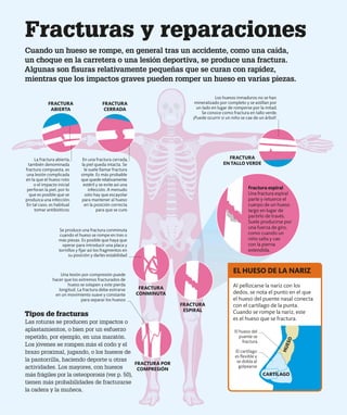 Tipos de fracturas
Las roturas se producen por impactos o
aplastamientos, o bien por un esfuerzo
repetido, por ejemplo, en una maratón.
Los jóvenes se rompen más el codo y el
brazo proximal, jugando, o los huesos de
la pantorrilla, haciendo deporte u otras
actividades. Los mayores, con huesos
más frágiles por la osteoporosis (ver p. 50),
tienen más probabilidades de fracturarse
la cadera y la muñeca.
La fractura abierta,
también denominada
fractura compuesta, es
una lesión complicada
en la que el hueso roto
o el impacto inicial
perforan la piel, por lo
que es posible que se
produzca una infección.
En tal caso, es habitual
tomar antibióticos.
Se produce una fractura conminuta
cuando el hueso se rompe en tres o
más piezas. Es posible que haya que
operar para introducir una placa y
tornillos y fijar así los fragmentos en
su posición y darles estabilidad
Una lesión por compresión puede
hacer que los extremos fracturados de
hueso se solapen y este pierda
longitud. La fractura debe estirarse
en un movimiento suave y constante
para separar los huesos
Los huesos inmaduros no se han
mineralizado por completo y se astillan por
un lado en lugar de romperse por la mitad.
Se conoce como fractura en tallo verde.
¡Puede ocurrir si un niño se cae de un árbol!
Al pellizcarse la nariz con los
dedos, se nota el punto en el que
el hueso del puente nasal conecta
con el cartílago de la punta.
Cuando se rompe la nariz, este
es el hueso que se fractura.
EL HUESO DE LA NARIZ
Fracturas y reparaciones
Cuando un hueso se rompe, en general tras un accidente, como una caída,
un choque en la carretera o una lesión deportiva, se produce una fractura.
Algunas son fisuras relativamente pequeñas que se curan con rapidez,
mientras que los impactos graves pueden romper un hueso en varias piezas.
H
U
E
S
O
CARTÍLAGO
FRACTURA
ABIERTA
FRACTURA
CERRADA
FRACTURA
EN TALLO VERDE
FRACTURA
CONMINUTA
FRACTURA POR
COMPRESIÓN
FRACTURA
ESPIRAL
El hueso del
puente se
fractura
El cartílago
es flexible y
se dobla al
golpearse
En una fractura cerrada,
la piel queda intacta. Se
le suele llamar fractura
simple. Es más probable
que quede relativamente
estéril y se evite así una
infección. A menudo
solo hay que escayolar
para mantener al hueso
en la posición correcta
para que se cure.
Fractura espiral
Una fractura espiral
parte y retuerce el
cuerpo de un hueso
largo en lugar de
partirlo de través.
Suele producirse por
una fuerza de giro,
como cuando un
niño salta y cae
con la pierna
extendida.
 