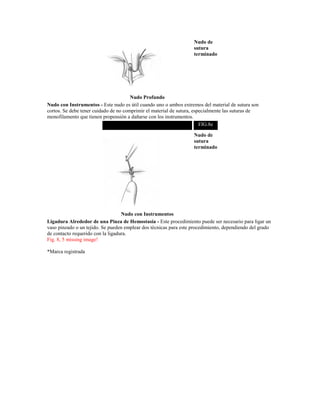 Nudo Profundo
Nudo de
sutura
terminado
Nudo con Instrumentos - Este nudo es útil cuando uno o ambos extremos del material de sutura son
cortos. Se debe tener cuidado de no comprimir el material de sutura, especialmente las suturas de
monofilamento que tienen propensión a dañarse con los instrumentos.
FIG.8e
Nudo con Instrumentos
Nudo de
sutura
terminado
Ligadura Alrededor de una Pinza de Hemostasia - Este procedimiento puede ser necesario para ligar un
vaso pinzado o un tejido. Se pueden emplear dos técnicas para este procedimiento, dependiendo del grado
de contacto requerido con la ligadura.
Fig. 8, 5 missing image!
*Marca registrada
 