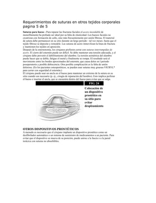 Requerimientos de suturas en otros tejidos corporales
pagina 5 de 5
Suturas para hueso - Para reparar las fracturas faciales el acero inoxidable de
monofilamento ha probado ser ideal por su falta de elasticidad. Los huesos faciales no
cicatrizan con formación de callo, sino más frecuentemente por unión fibrosa. El material
de sutura debe permanecer en su sitio durante un largo periodo - tal vez meses -hasta que el
tejido fibroso se deposite y remodele. Las suturas de acero inmovilizan la línea de fractura
y mantienen los tejidos en aposición.
Después de la esternotomía, los cirujanos prefieren cerrar con suturas interrumpidas de
acero. El cierre del esternón puede ser difícil. Se debe mantener una tensión adecuada, y el
cirujano debe prevenir el debilitamiento del alambre. La torsión asimétrica del alambre
puede hacer que se doble, fatigue el metal y finalmente se rompa. El resultado será el
movimiento entre los bordes aproximados del esternón, que causa dolor en l periodo
posoperatorio y posible dehiscencia. Otra posible complicación es la falta de unión
dolorosa. (En los pacientes osteoporóticos, se pueden usar suturas muy gruesas VICRYL*
para cerrar con seguridad el esternón.)
El cirujano puede usar un ancla en el hueso para mantener un extremo de la sutura en su
sitio cuando sea necesario (p. ej., cirugía de reparación del hombro). Esto implica perforar
el hueso e insertar el ancla, que se encuentra dentro del hueso para evitar que se salga.
FIG. 24
Colocación de
un dispositivo
prostético en
su sitio para
evitar
desplzamiento
OTROS DISPOSITIVOS PROSTÉTICOS
A menudo es necesario que el cirujano implante un dispositivo prostético como un
desfibrilador automático o un sistema de suministro de medicamentos a un paciente. Para
evitar que el dispositivo se mueva de su posición, puede unirse a la fascia o a la pared
torácica con suturas no absorbibles.
 