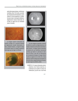 67
patía óptica glaucomatosa, insuficiencia
carotídea y otros. Por lo tanto, ya existen
las composiciones farmacéuticas, que se
utilizan en forma terapéutica o profilác-
tica para tratar la retinopatía diabética o
degeneración macular relacionada con
la edad, en alguna de sus variedades
(seca o húmeda).
La imagen superior demuestra los
cambios iniciales en un paciente afectado
por degeneración macular relacionada a la
edad, variedad húmeda. La imagen de abajo
es la historia natural, en donde se aprecia la
hemorragia que da origen a la fibrosis.
Las dos imágenes siguientes muestran
la diferencia cuando las degeneraciones son
tratadas mediante la estimulación de la fotosín-
tesis humana. La imagen superior demuestra
la presencia de una membrana neovascular
coroidea que todavía no atraviesa la mem-
brana de Bruch, pues ello se demostraría
por la presencia de sangre; la imagen inferior
muestra el aspecto de la retina tres meses
después, donde se aprecia que al recuperar su
forma (la retina o específicamente la mácula),
la visión mejoró de 20/200 a 20/25.
EJEMPLO 8.- En apoyo del ejemplo anterior
citaremos cinco hechos descritos en
la literatura que suceden al activar los
melanocitos y que de una u otra forma
IMPACTO DE LA FOTOSÍNTESIS HUMANA EN OTRAS ÁREAS DEL CONOCIMIENTO
 