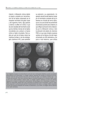 76
rritación o inflamación crónica debido
al impacto constante por inercia/trac-
ción de los tejidos ocasionado por el
incesante movimiento del globo ocular
y del organismo mismo, algo parecido
a enterrar un alfiler en la retina, lo que
da como resultado del movimiento ocular
que las distintas inercias de los tejidos
circundantes van a producir un trauma
crónico al tejido circundante. Esto ex-
plica por qué con el tiempo crecen las
cicatrices de láser (y de otra etiología,
pero cicatrices al fin), pues aumentan
su extensión y su pigmentación. Un
ejemplo natural de este deterioro tisular
por el movimiento constante del ojo lo
tenemos en el borde del nervio óptico,
que es una zona donde frecuentemente
encontramos aumento de la melanina, lo
que refleja la activación de los melanoci-
tos por la inflamación crónica o bien
la activación del sistema de citocromo
P450, en cuyo caso el tejido se aprecia
verdoso con luz blanca y de color negro
al iluminarlo con 450 nanómetros y con
poca o nula melanina, pues ambos
MELANINA, LA CLOROFILA HUMANA, SU PAPEL EN EL ORIGEN DE LA VIDA
Las imágenes muestran la extraordinaria evolución de la retinopatía diabética cuando se emplean
estimulantes de la fotosíntesis. La imagen superior izquierda fue tomada al momento de la eva-
luación inicial de este paciente masculino de 35 años de edad, con diabetes mellitus tipo 1, de
12 años de evolución. Ese día el paciente llegó al consultorio guiado por su anciana madre, pues
el otro ojo lo había perdido 6 meses antes. La imagen superior derecha se tomó una semana
después de iniciado el tratamiento (estimulación farmacológica de la fotosíntesis humana). El
efecto es indiscutible. Baste decir que el paciente se presentó solo al consultorio, pues su visión
había mejorado lo suficiente para permitir la deambulación del mismo. La imagen inferior izquierda
se tomó dos semanas después de iniciado el tratamiento y, por último, la imagen inferior derecha
a las cuatro semanas.
 