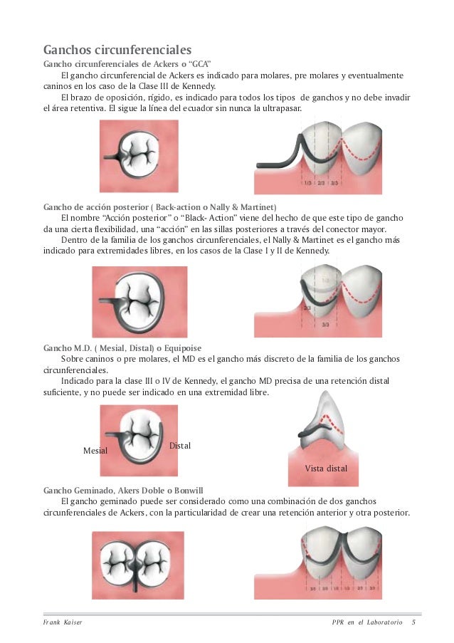 protesis parcial removible