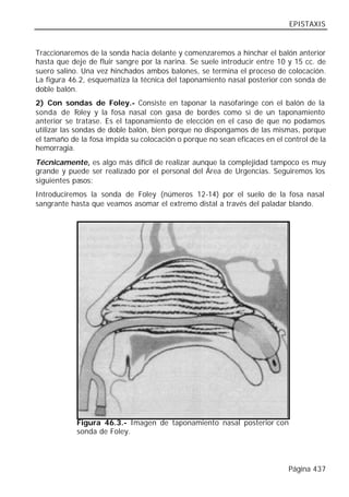 EPISTAXIS


Traccionaremos de la sonda hacia delante y comenzaremos a hinchar el balón anterior
hasta que deje de fluir sangre por la narina. Se suele introducir entre 10 y 15 cc. de
suero salino. Una vez hinchados ambos balones, se termina el proceso de colocación.
La figura 46.2, esquematiza la técnica del taponamiento nasal posterior con sonda de
doble balón.
2) Con sondas de Foley.- Consiste en taponar la nasofaringe con el balón de la
sonda de F    oley y la fosa nasal con gasa de bordes como si de un taponamiento
anterior se tratase. Es el taponamiento de elección en el caso de que no podamos
utilizar las sondas de doble balón, bien porque no dispongamos de las mismas, porque
el tamaño de la fosa impida su colocación o porque no sean eficaces en el control de la
hemorragia.
Técnicamente, es algo más difícil de realizar aunque la complejidad tampoco es muy
grande y puede ser realizado por el personal del Área de Urgencias. Seguiremos los
siguientes pasos:
Introduciremos la sonda de Foley (números 12-14) por el suelo de la fosa nasal
sangrante hasta que veamos asomar el extremo distal a través del paladar blando.




            Figura 46.3.- Imagen de taponamiento nasal posterior con
            sonda de Foley.




                                                                           Página 437
 