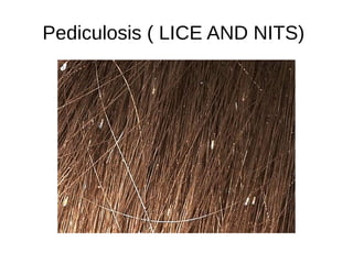 Pediculosis ( LICE AND NITS)
 