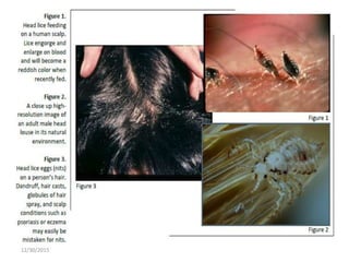 Lice | PPTX