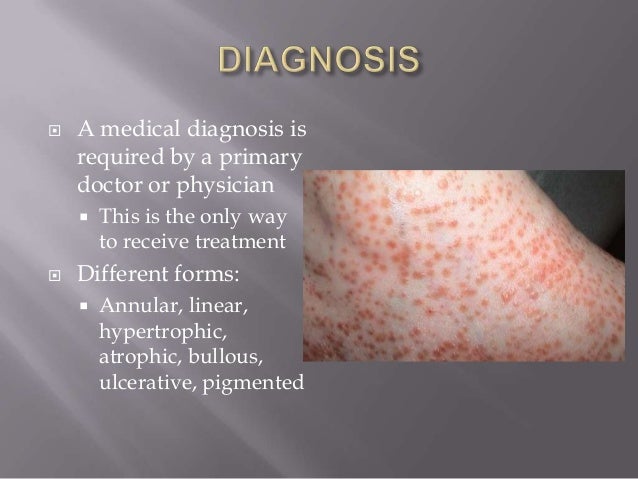 lichen nitidus home remedies