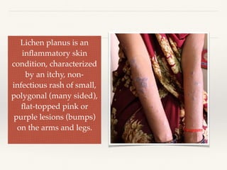 Lichen plannus cured case study | PDF