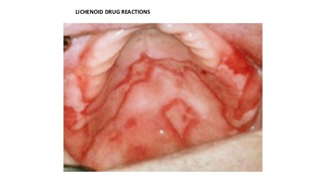 Oral Lichen Planus - AAOM