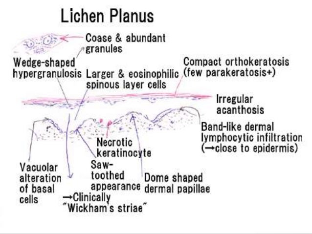 Lichen planus alopecia skin diagram 