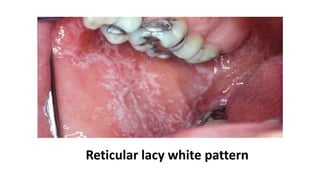 Lichen planus | PPTX