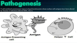 Pathogenesis
T-cell-mediated autoimmune injury to basal keratinocytes whose surface self-antigens have been altered
by Trauma or Infection (Altered MHC, HLA ).
 