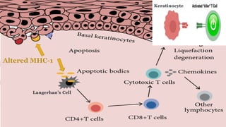Keratinocyte
Langerhan’s Cell
 