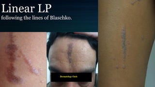 Linear LP
following the lines of Blaschko.
 