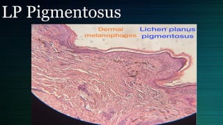 LP Pigmentosus
 