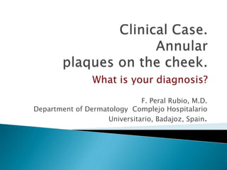 Clinical Case. Annularplaques on the cheek.Whatisyourdiagnosis? F. Peral Rubio, M.D.Department of Dermatology  Complejo Hospitalario Universitario, Badajoz, Spain. 
