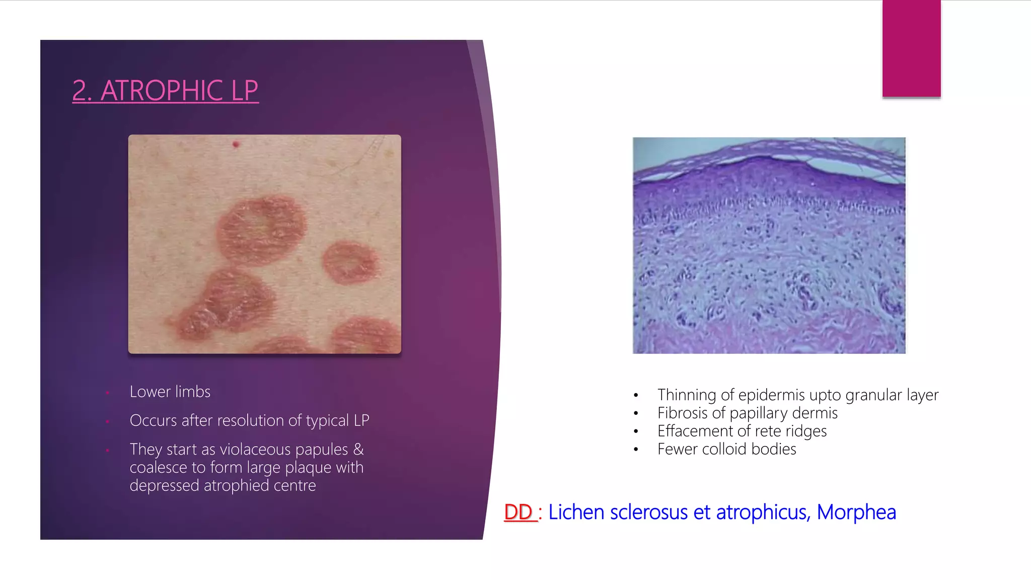 Lichen planus and lichenoid disorders | PPTX