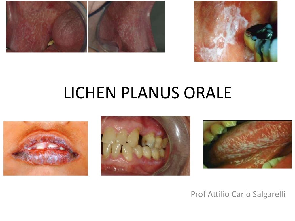 Lichen planus orale