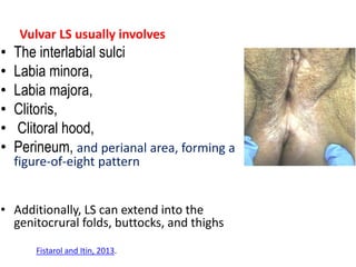 Vulvar LS usually involves
• The interlabial sulci
• Labia minora,
• Labia majora,
• Clitoris,
• Clitoral hood,
• Perineum, and perianal area, forming a
figure-of-eight pattern
• Additionally, LS can extend into the
genitocrural folds, buttocks, and thighs
Fistarol and Itin, 2013.
 