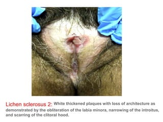 Lichen sclerosus 2: White thickened plaques with loss of architecture as
demonstrated by the obliteration of the labia minora, narrowing of the introitus,
and scarring of the clitoral hood.
 